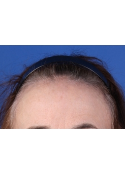 Before Hair Transplant&nbsp;Hairline